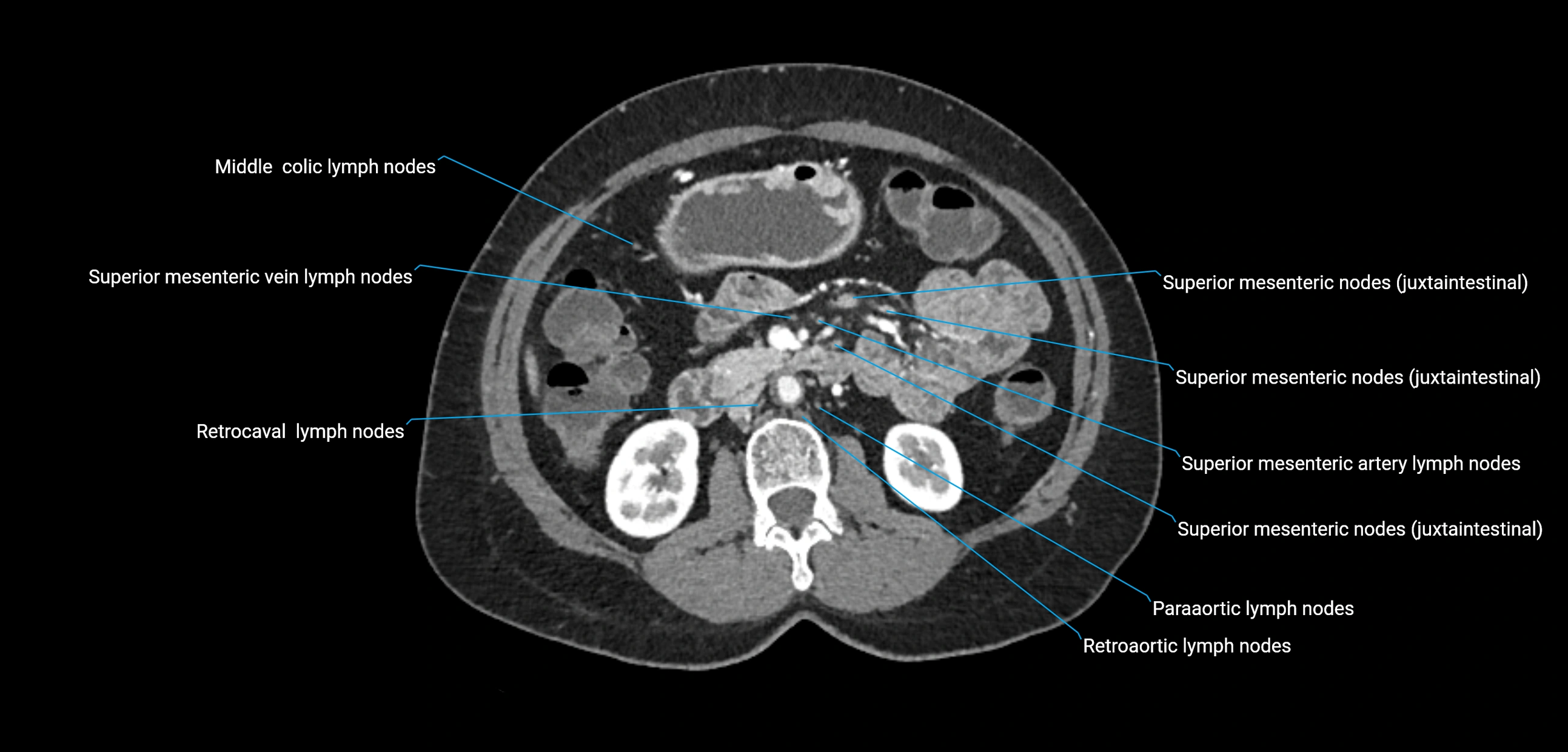 CT ct abdominal lymph nodes  axial cross sectional anatomy  enchanced radiology image -img-00002-00198.webp